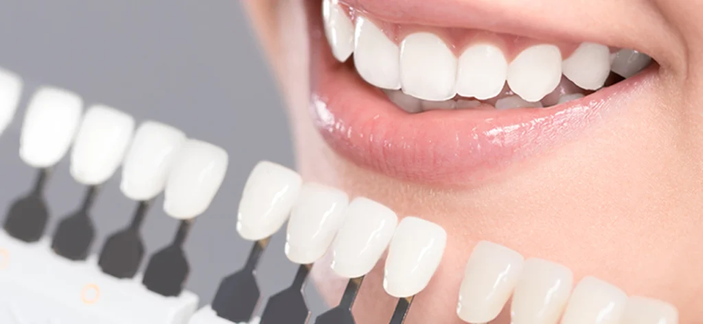 ästhetischste Lösung für Frontzähne im Vergleich zu Metallkeramik