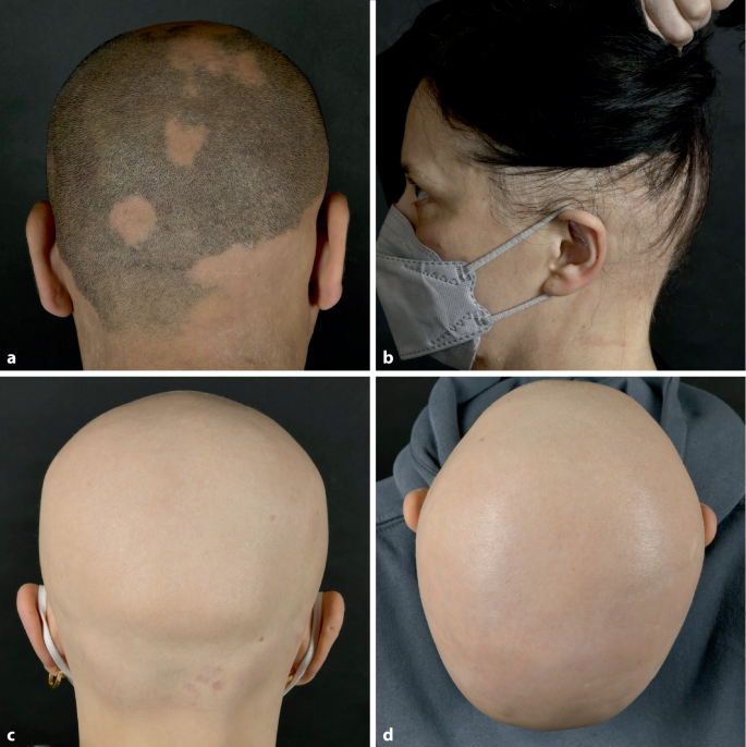 Alopecia Areata totalis und universalis