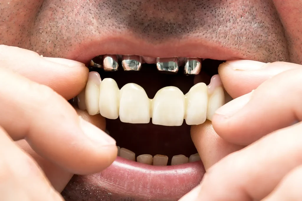 Teleskopprothesen in der Türkei