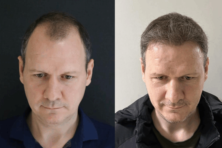 Haartransplantation 2026 Rückblick