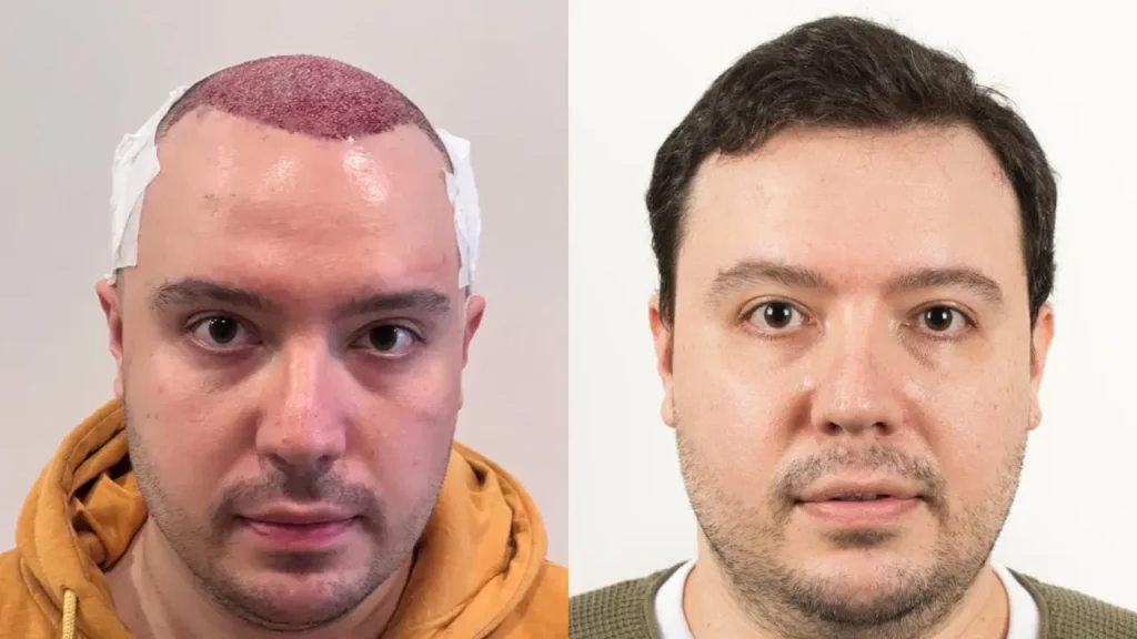 Haartransplantation Garantie-Urkunden