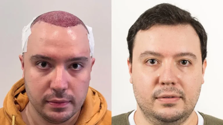 Haartransplantation Garantie-Urkunden