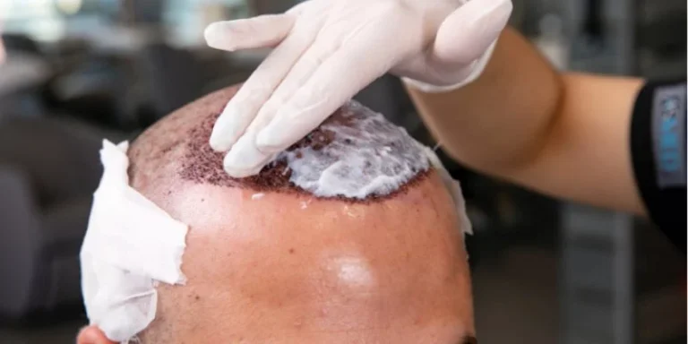 Haartransplantation Nachsorge in Deutschland