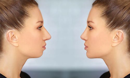 Kinnkorrektur (Genioplastik) in der Türkei