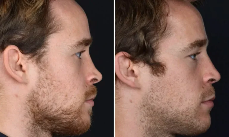 Nasenkorrektur für Männer