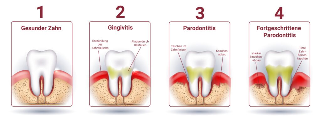 Parodontitis und Implantate