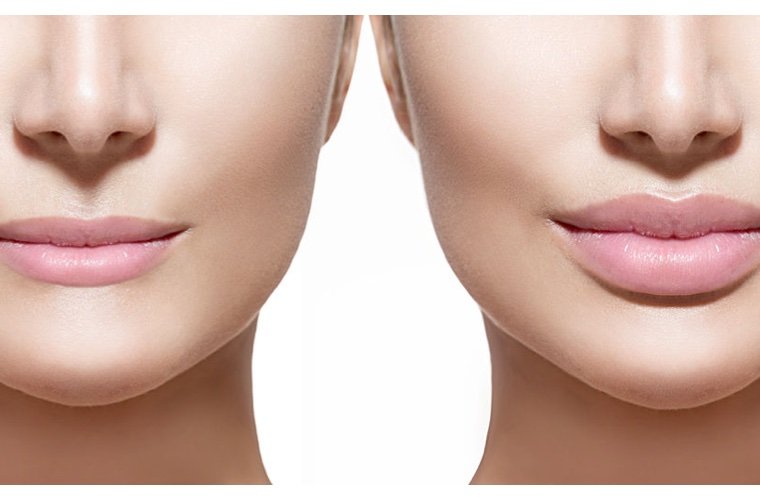 Lippenvergrößerung in Türkei