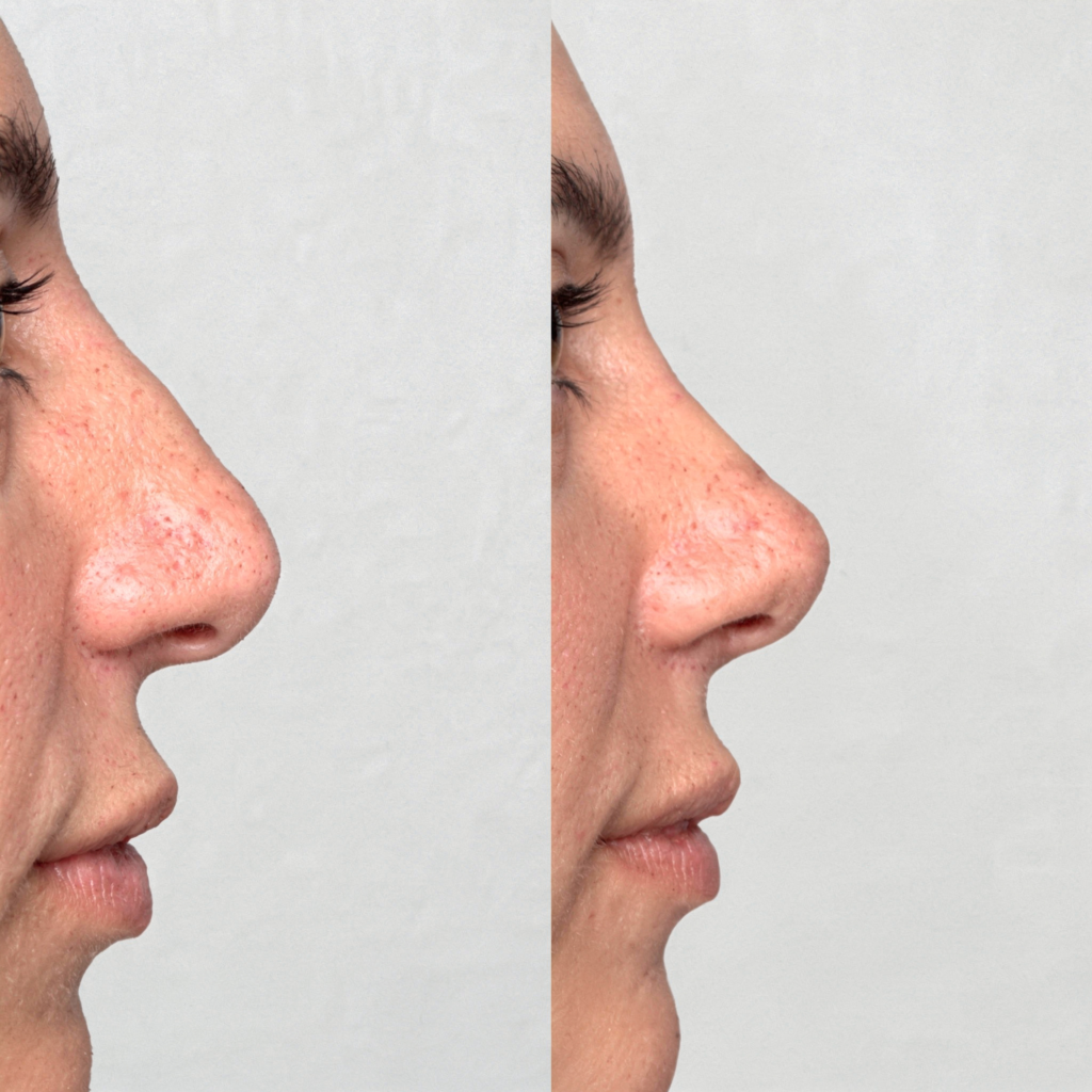 nicht-chirurgische Nasenkorrektur