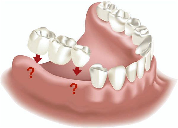 Fehlende Backenzähne