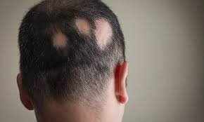 Alopecia Areata totalis