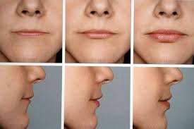 Lippenvergrößerung