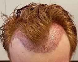 Haarausfall am Scheitel