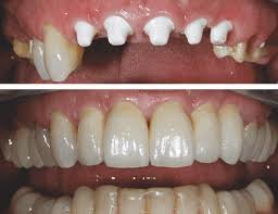 Zahnimplantate bei Bluthochdruck