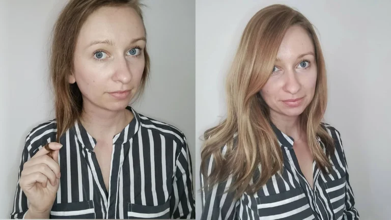 androgenetische bei Frauen