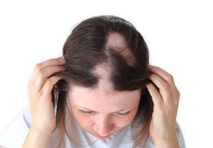 Haarausfall durch Eisenmangel