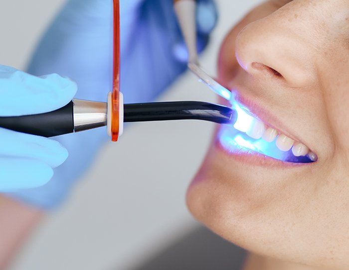 Komposit-Bonding in Antalya