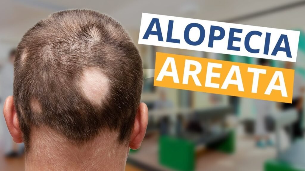 Alopecia Areata