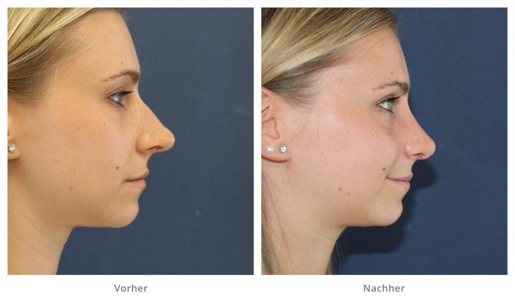 nicht-chirurgische Nasenkorrektur