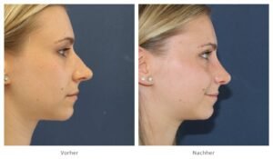 nicht-chirurgische Nasenkorrektur