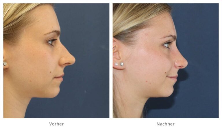 nicht-chirurgische Nasenkorrektur