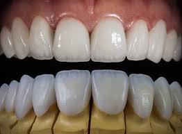 Composite Bonding vs. Keramik-Veneers
